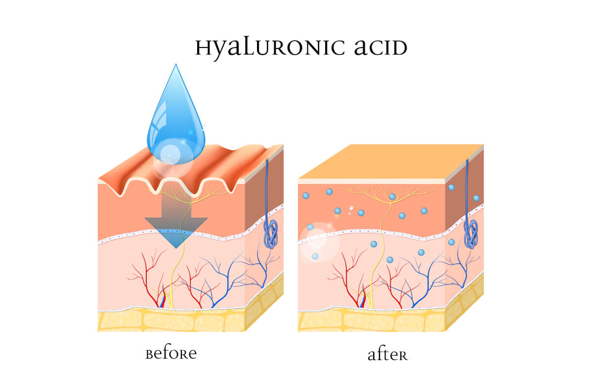 Infographic of skin before and after hyaluronic acid is used