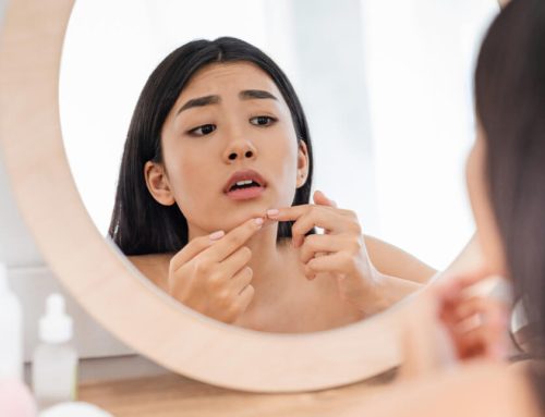 What Your Acne is Trying to Tell You About Your Health