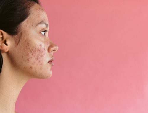 14 Hidden Causes of Acne You Never Knew About