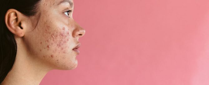 woman acne