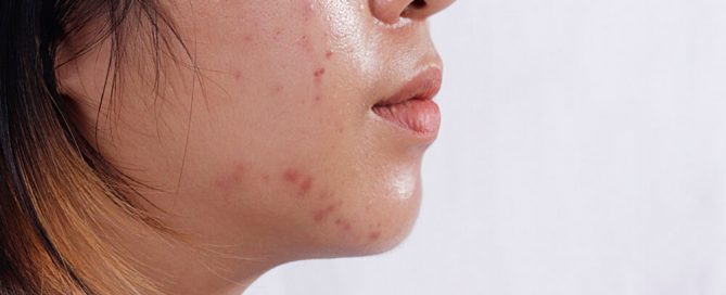 woman acne oily skin