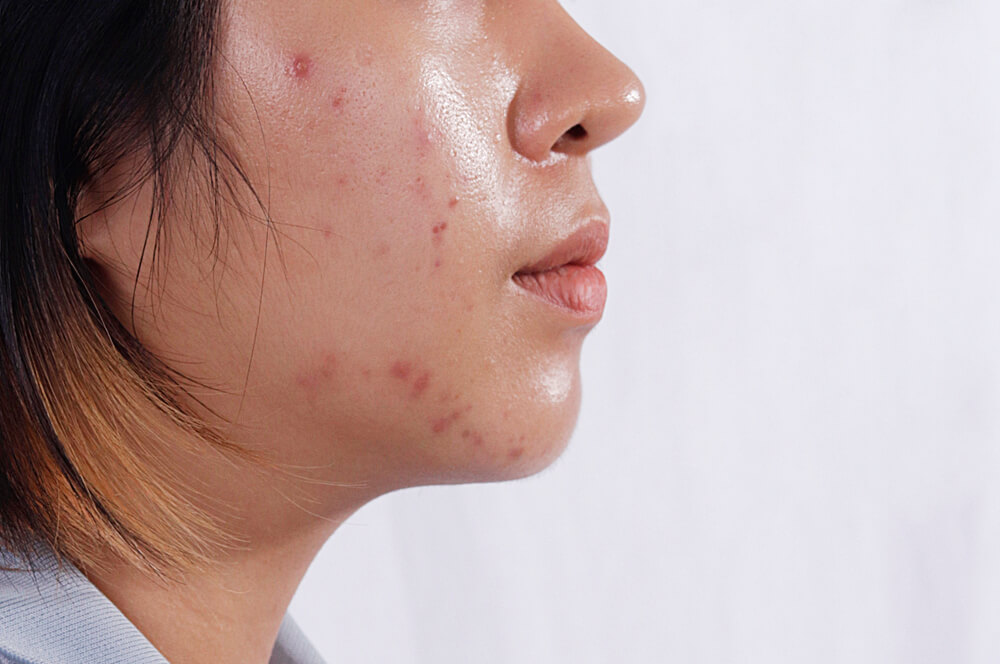 8 Best Products For Acne-Prone Oily Skin