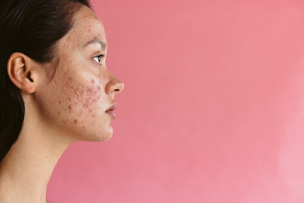 14 Hidden Causes of Acne You Never Knew About